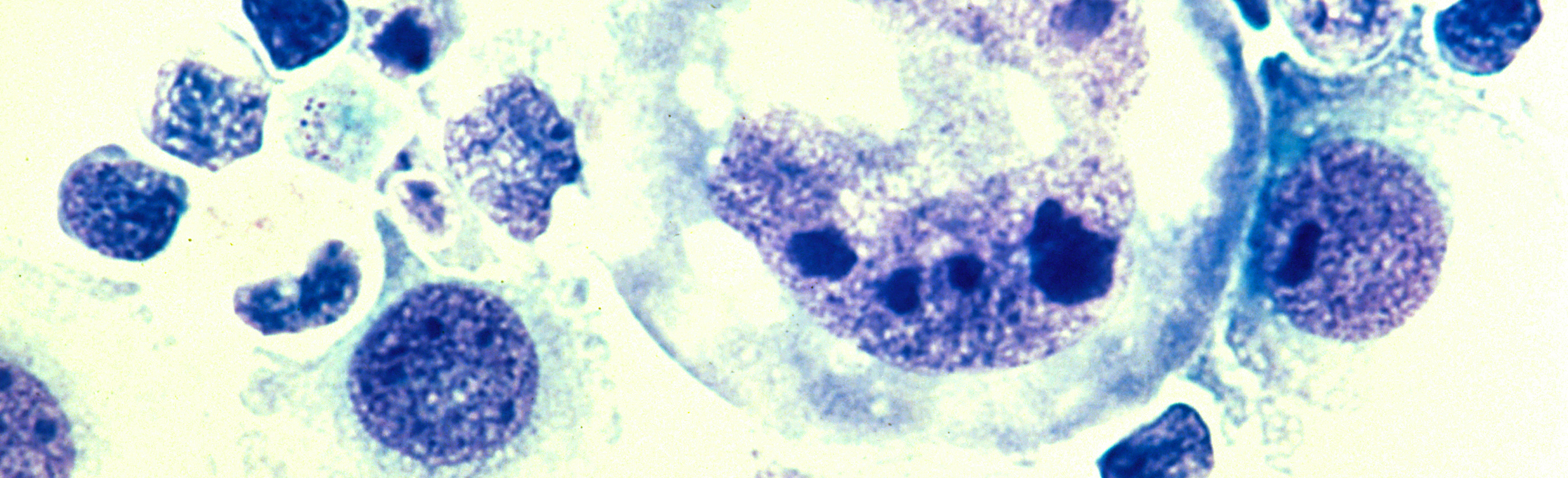 Treatment Guidelines for Breast Implant-Associated Anaplastic Large ...